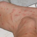 bed bug bites symptoms pictures