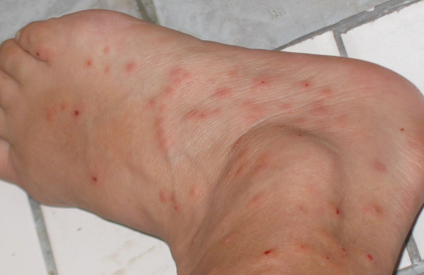 allergic reaction to bed bug bites